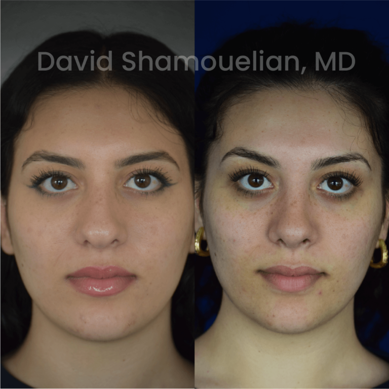 allure-bh-before-after-posts-pt-38-01