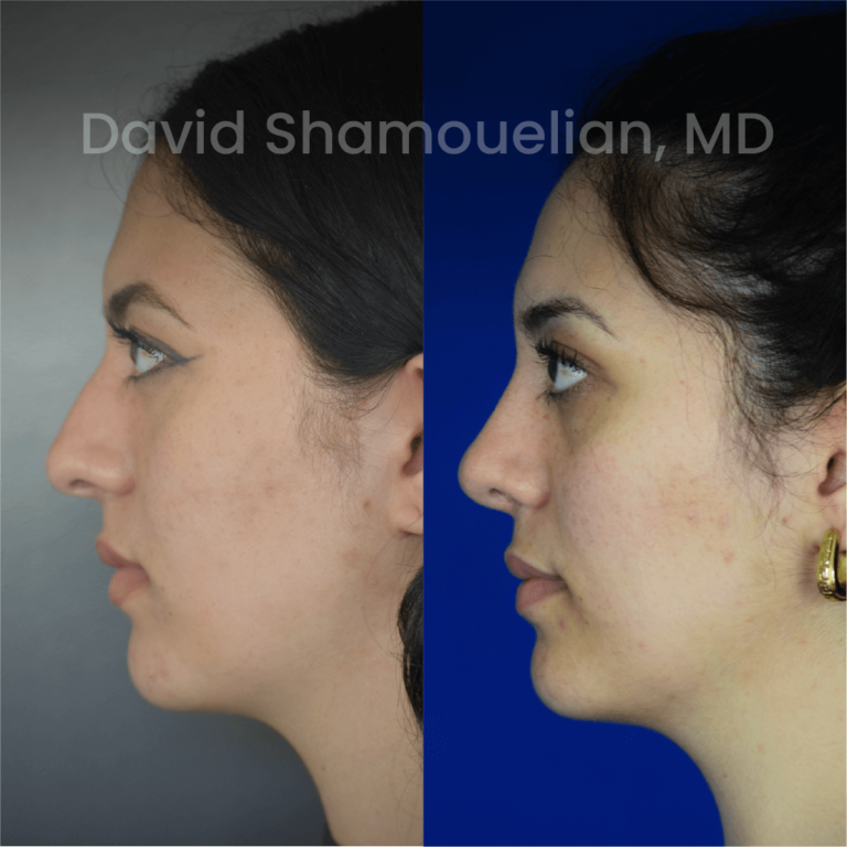 allure-bh-before-after-posts-pt-38-02
