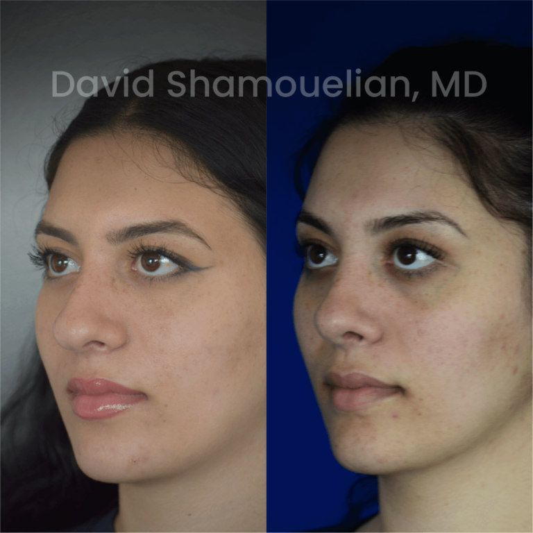 allure-bh-before-after-posts-pt-38-03