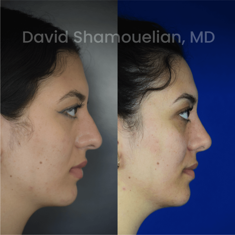 allure-bh-before-after-posts-pt-38-04