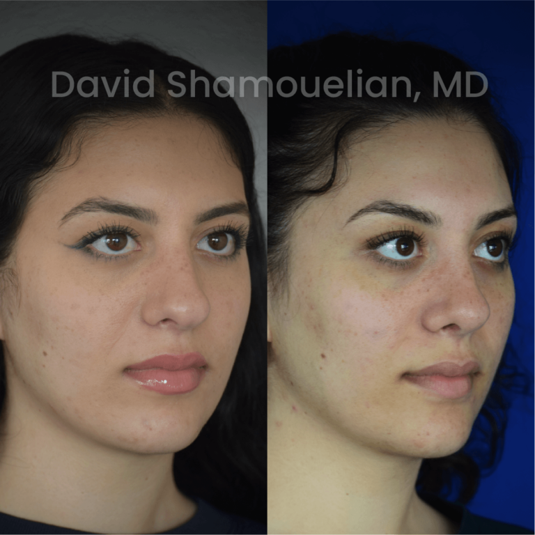 allure-bh-before-after-posts-pt-38-05