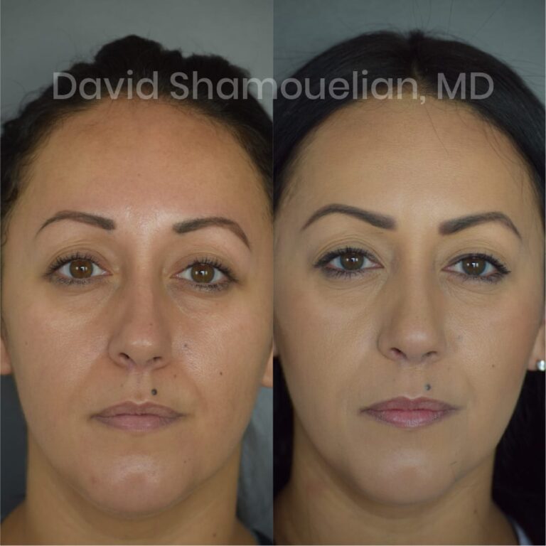 allure-bh-before-after-posts-pt-4-6-01