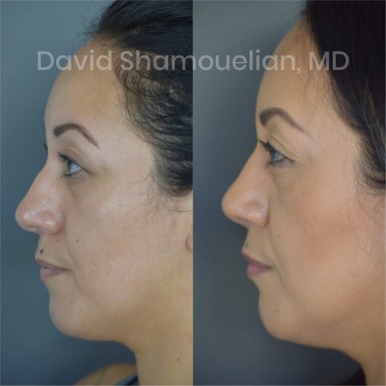 allure-bh-before-after-posts-pt-4-6-02