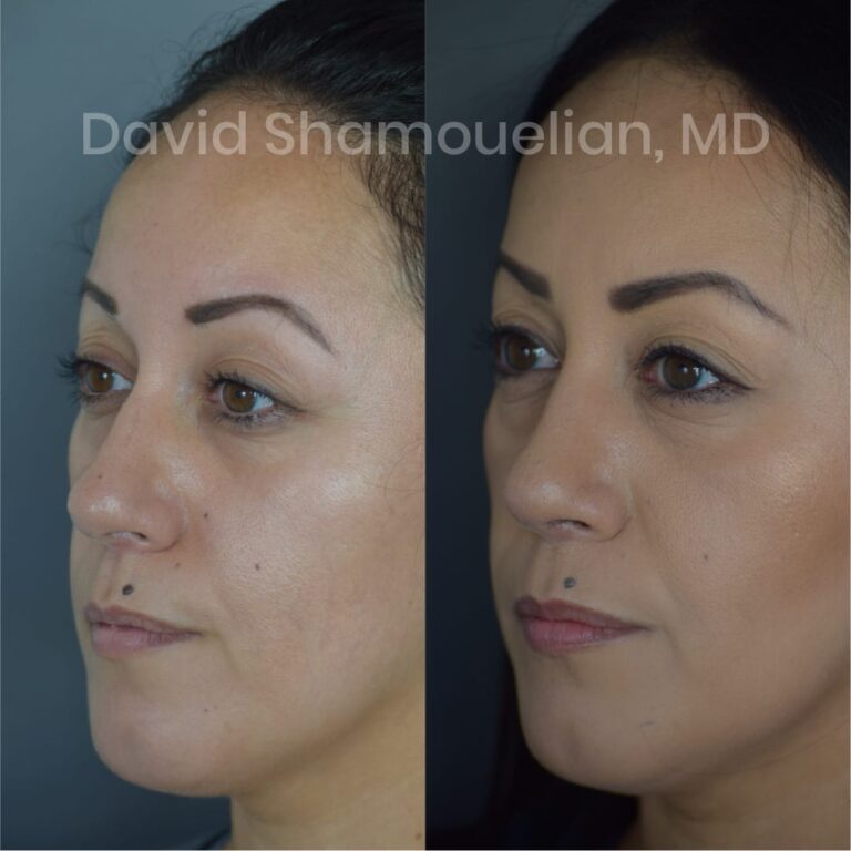 allure-bh-before-after-posts-pt-4-6-03