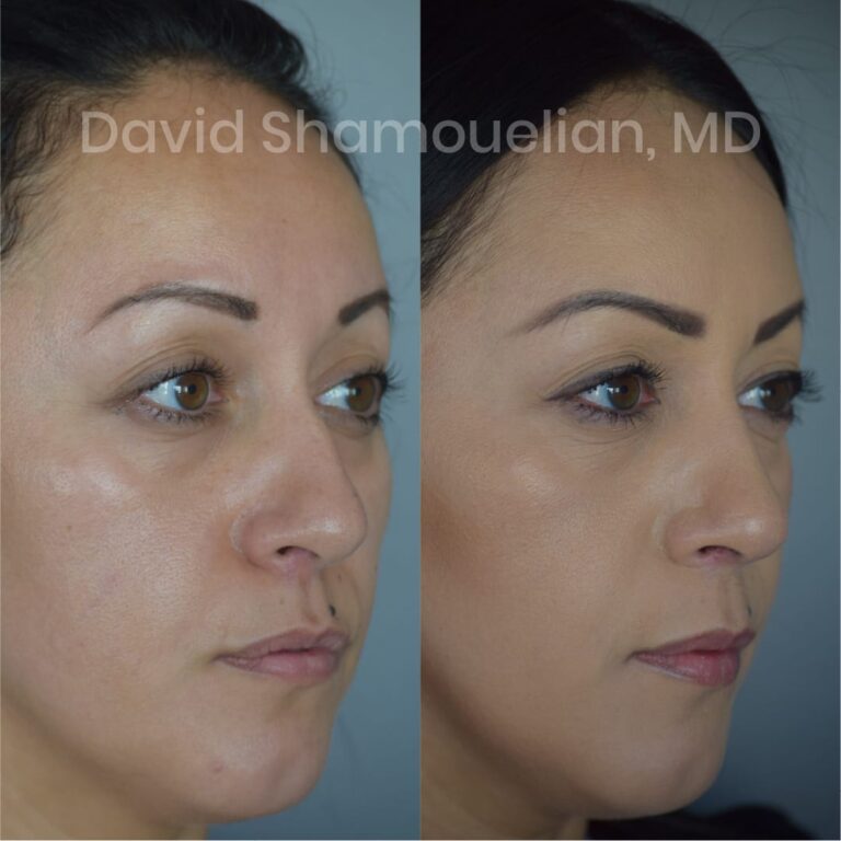 allure-bh-before-after-posts-pt-4-6-04