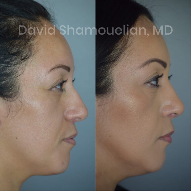 allure-bh-before-after-posts-pt-4-6-05