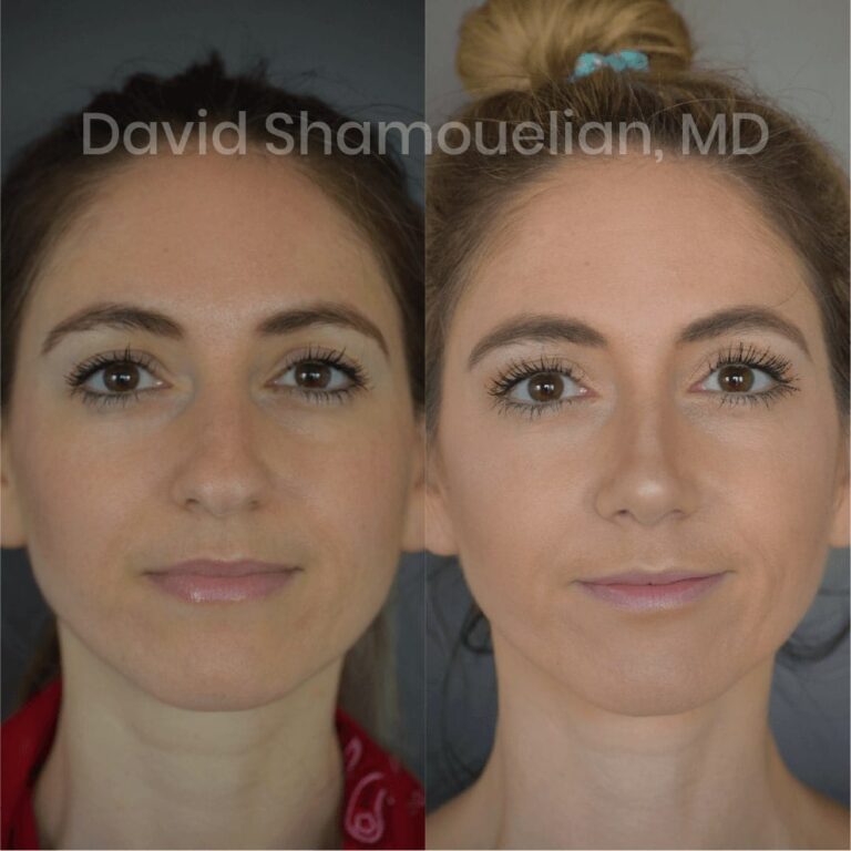 allure-bh-before-after-posts-pt-4-6-07