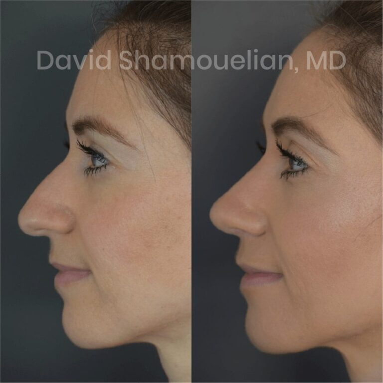 allure-bh-before-after-posts-pt-4-6-08