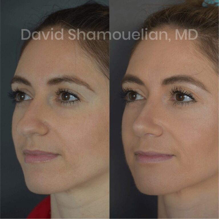 allure-bh-before-after-posts-pt-4-6-09