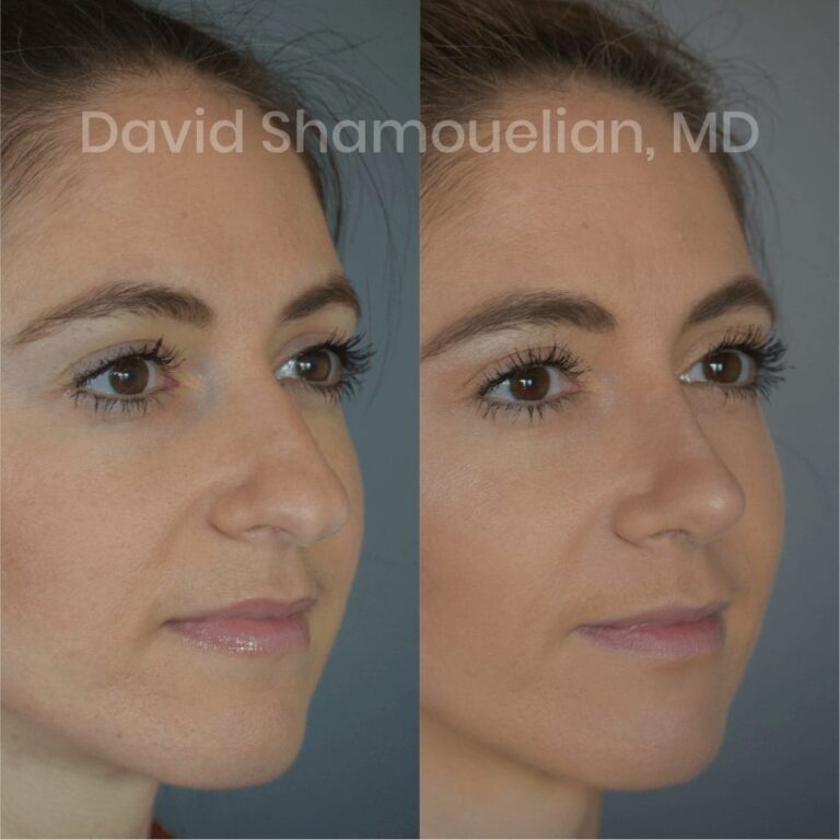 allure-bh-before-after-posts-pt-4-6-10