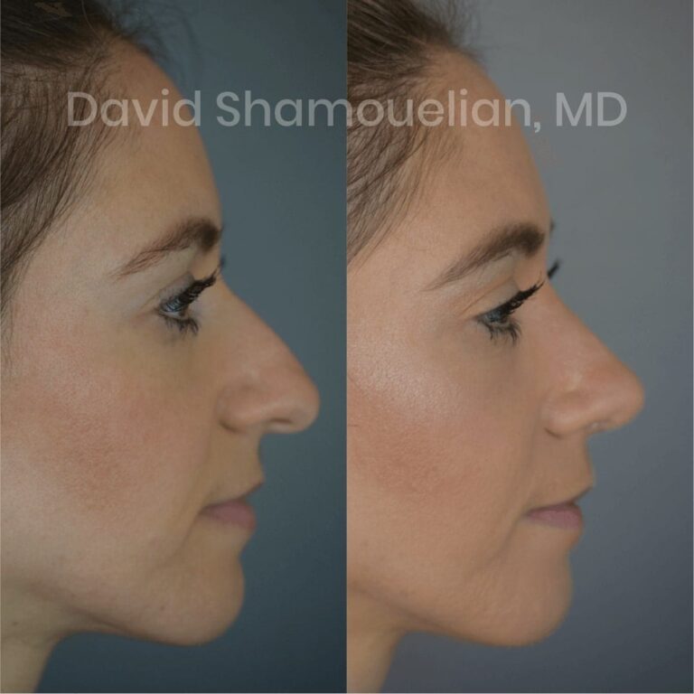 allure-bh-before-after-posts-pt-4-6-11