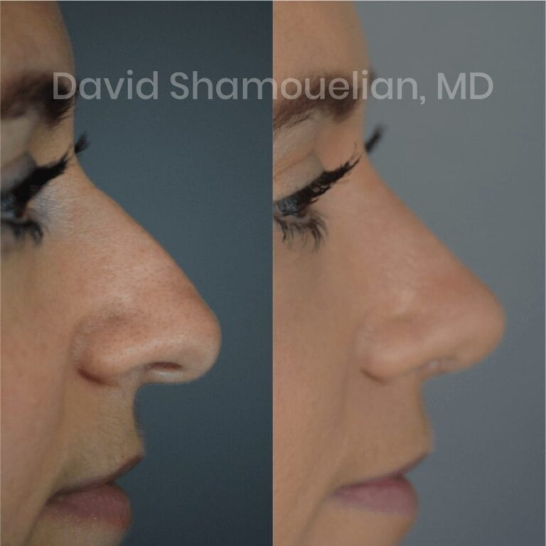 allure-bh-before-after-posts-pt-4-6-13