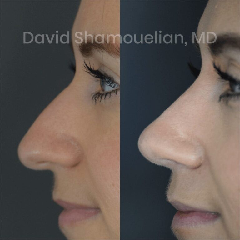 allure-bh-before-after-posts-pt-4-6-14