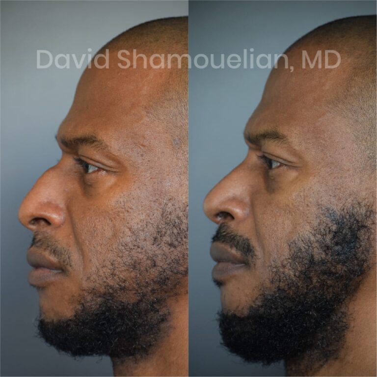 allure-bh-before-after-posts-pt-7-9-02