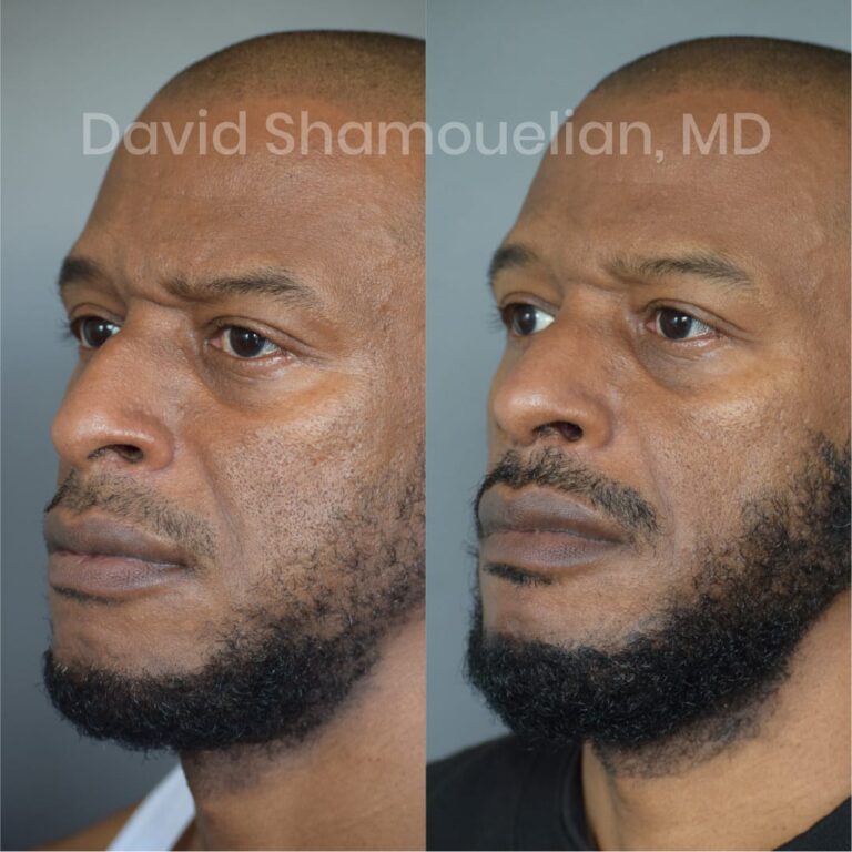 allure-bh-before-after-posts-pt-7-9-03