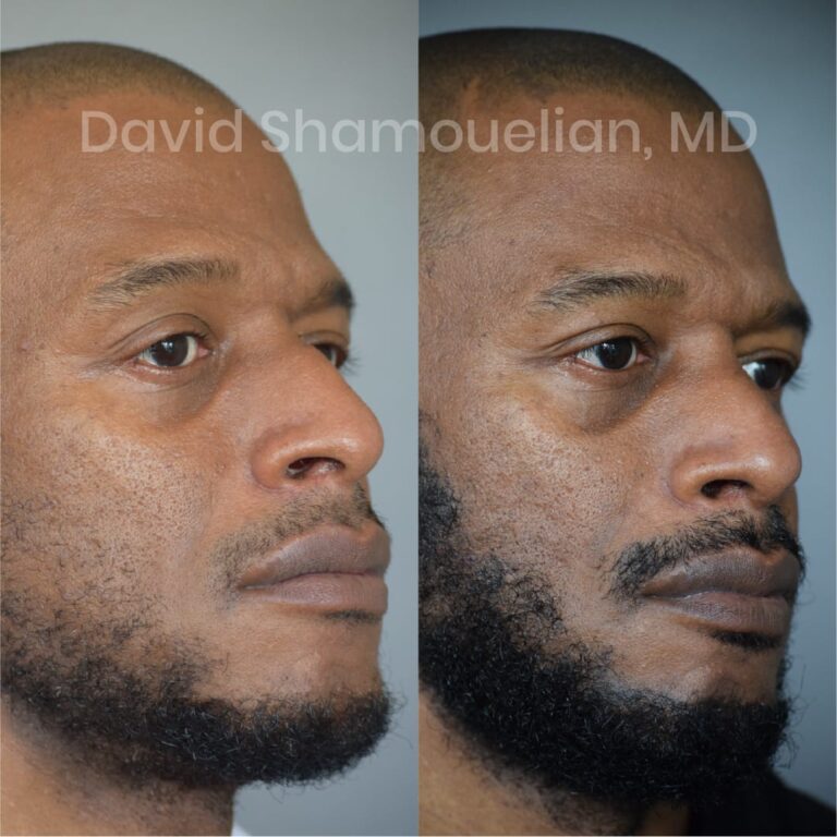 allure-bh-before-after-posts-pt-7-9-04