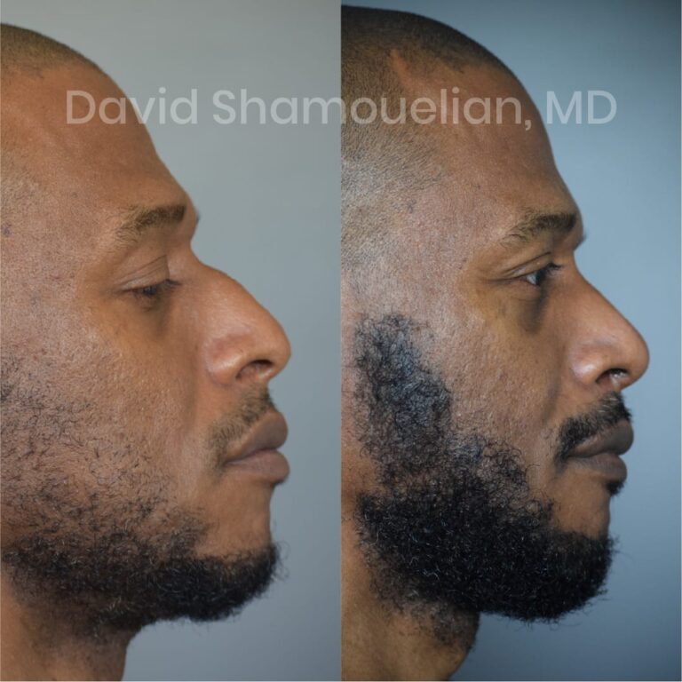 allure-bh-before-after-posts-pt-7-9-05