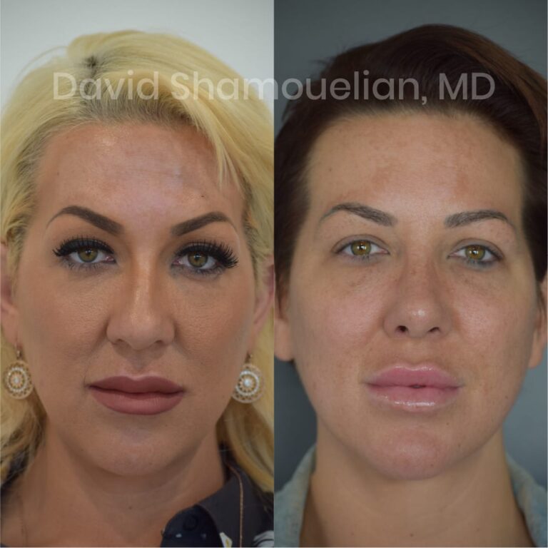 allure-bh-before-after-posts-pt-7-9-06