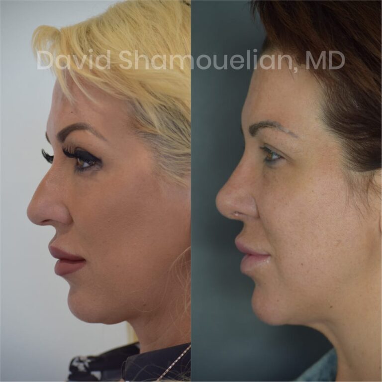 allure-bh-before-after-posts-pt-7-9-07