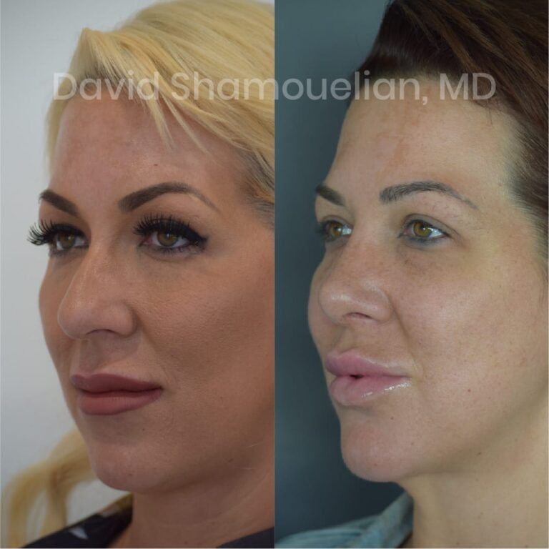 allure-bh-before-after-posts-pt-7-9-08