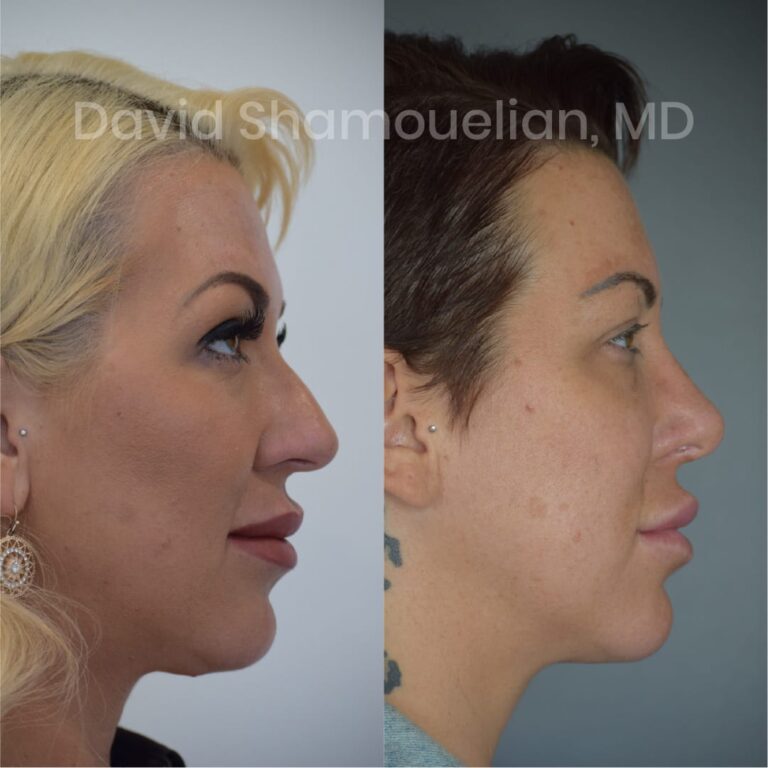allure-bh-before-after-posts-pt-7-9-09