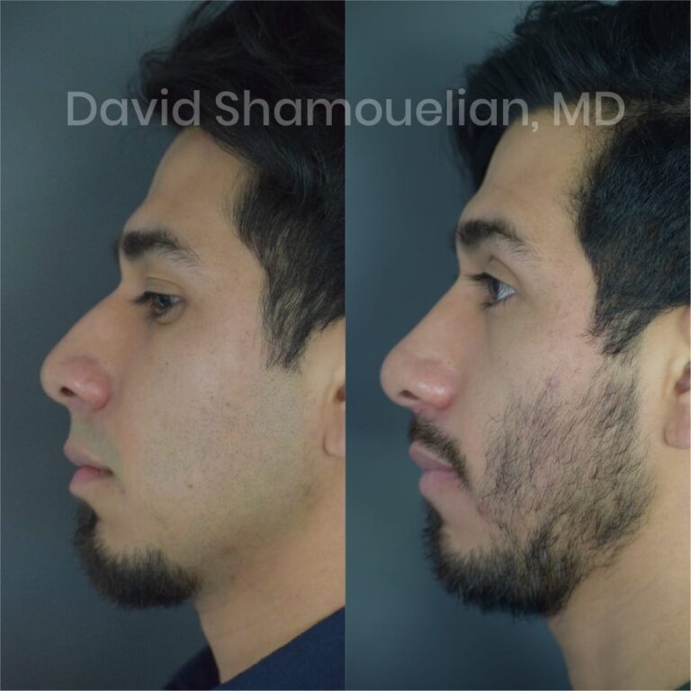 allure-bh-before-after-posts-pt-7-9-11