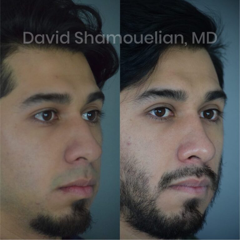 allure-bh-before-after-posts-pt-7-9-13