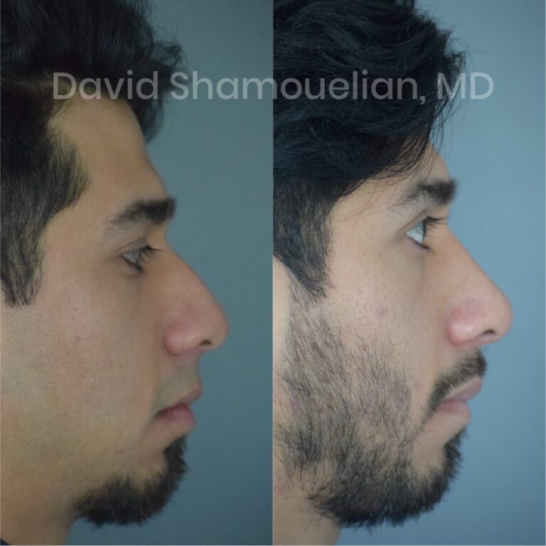 allure-bh-before-after-posts-pt-7-9-14