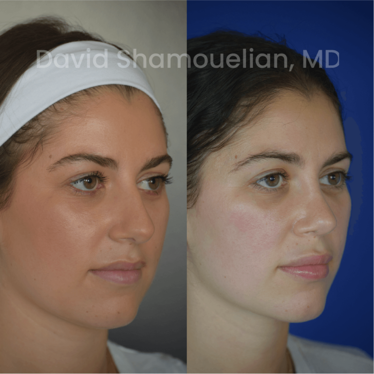 allure-bh-before-after-rhino-pt-29-02