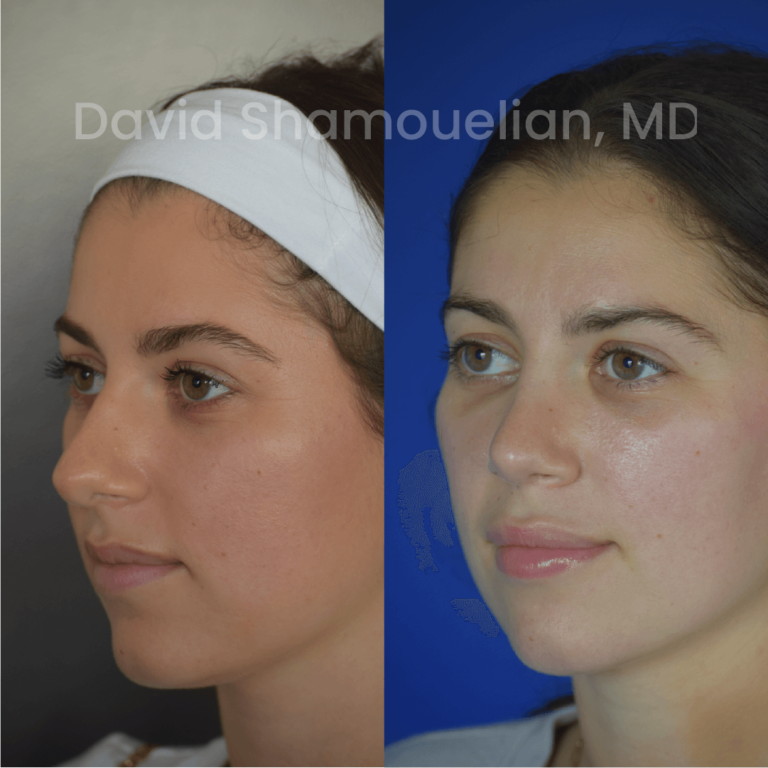 allure-bh-before-after-rhino-pt-29-05