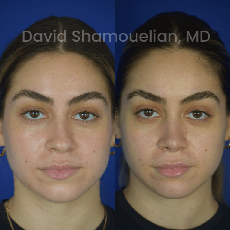 allure-bh-before-after-rhino-pt-30-01