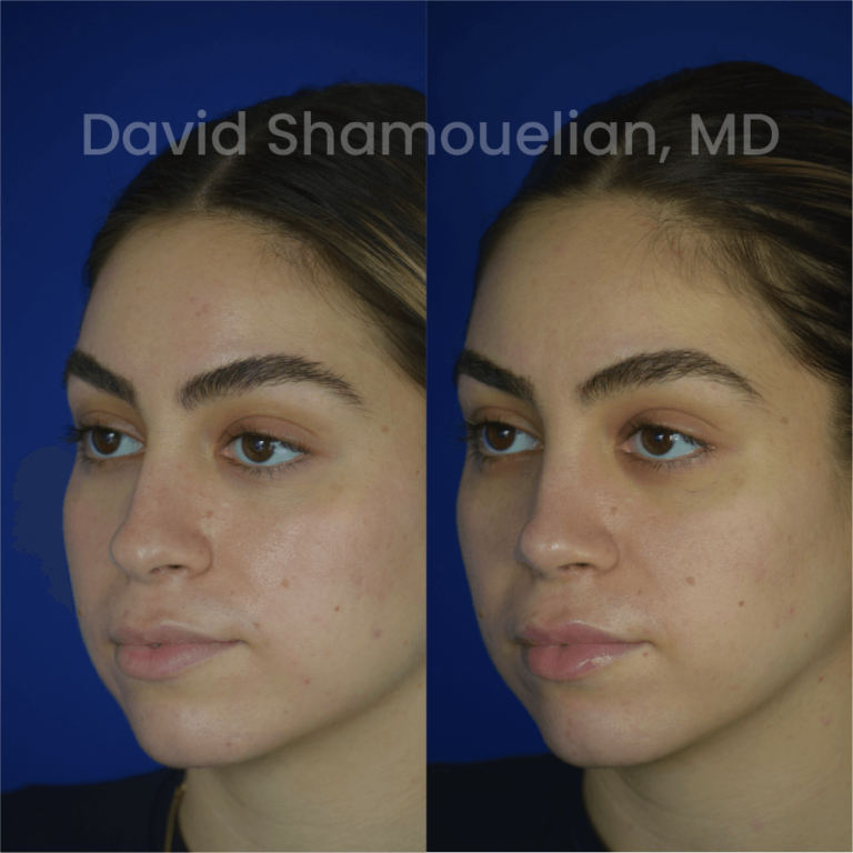 allure-bh-before-after-rhino-pt-30-02