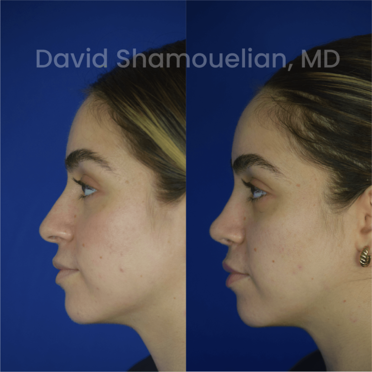 allure-bh-before-after-rhino-pt-30-03
