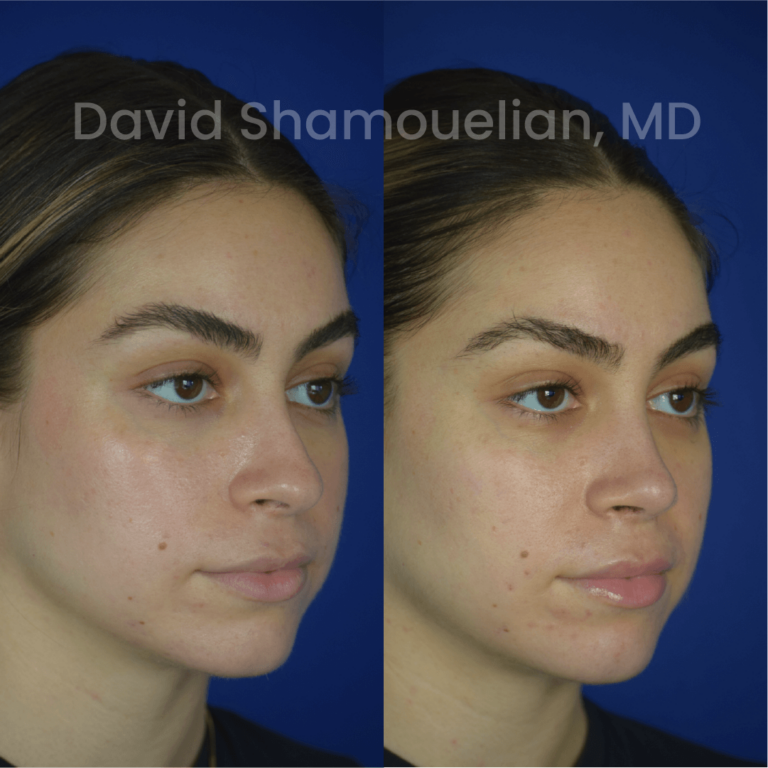 allure-bh-before-after-rhino-pt-30-04