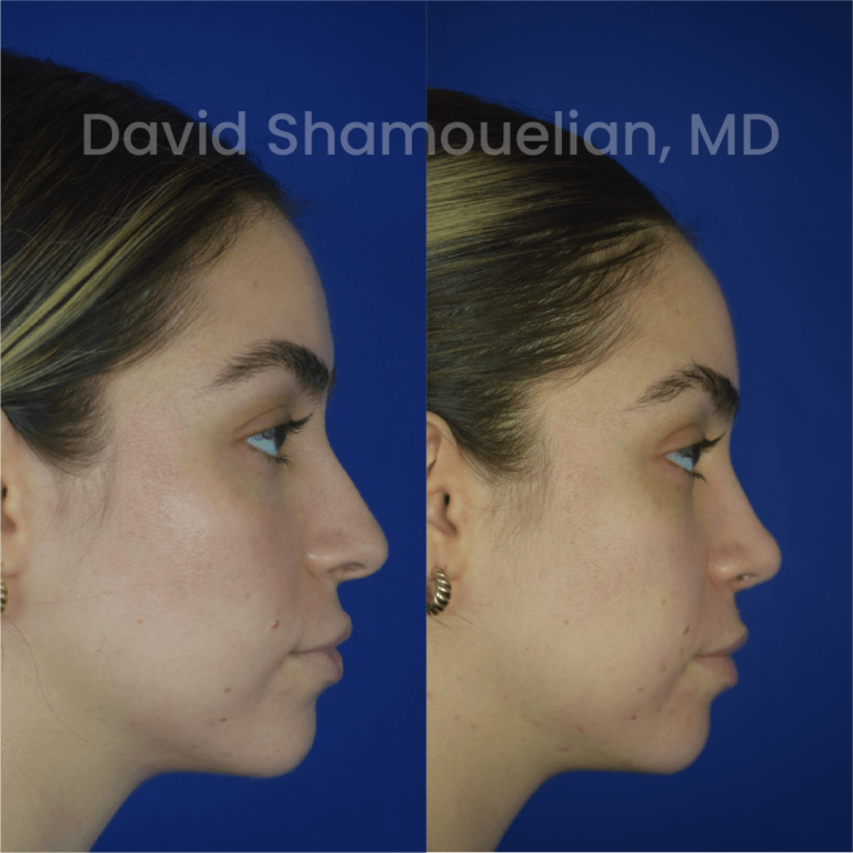 allure-bh-before-after-rhino-pt-30-05