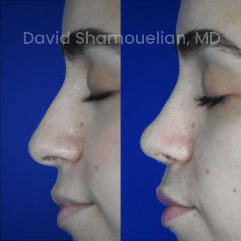 allure-bh-before-after-rhino-pt-30-06