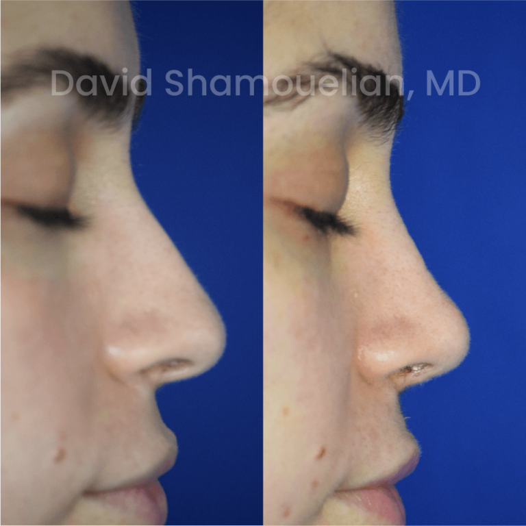 allure-bh-before-after-rhino-pt-30-07