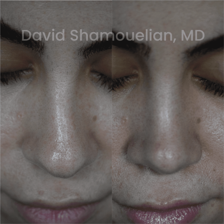 allure-bh-before-after-rhino-pt-30-10