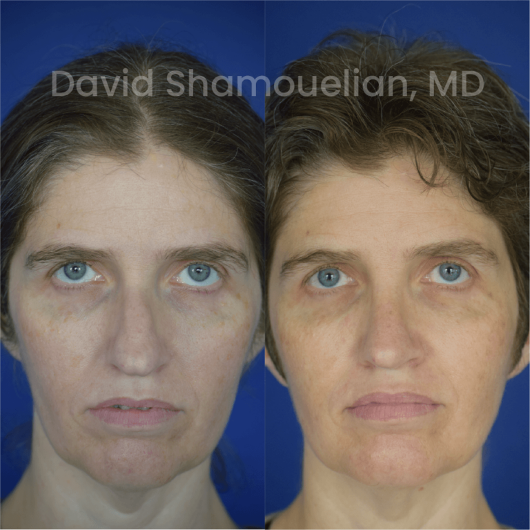 allure-bh-before-after-rhino-pt-31-01
