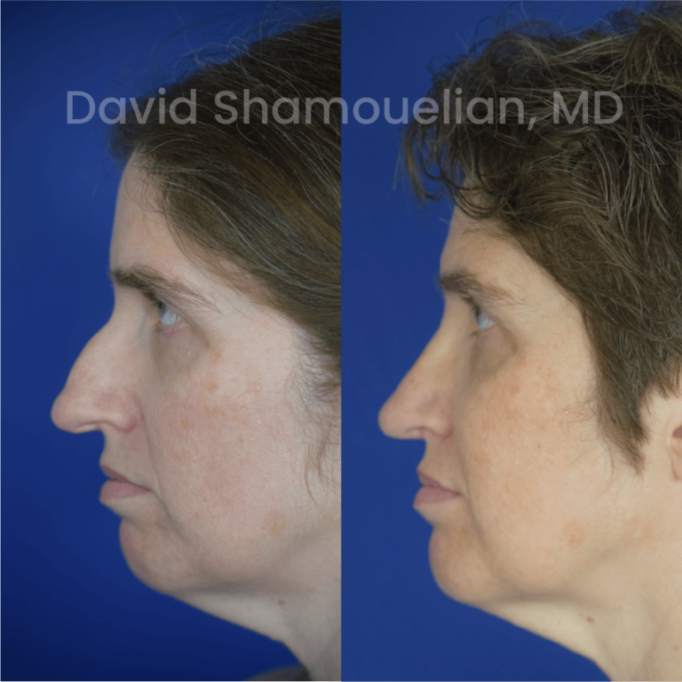 allure-bh-before-after-rhino-pt-31-03