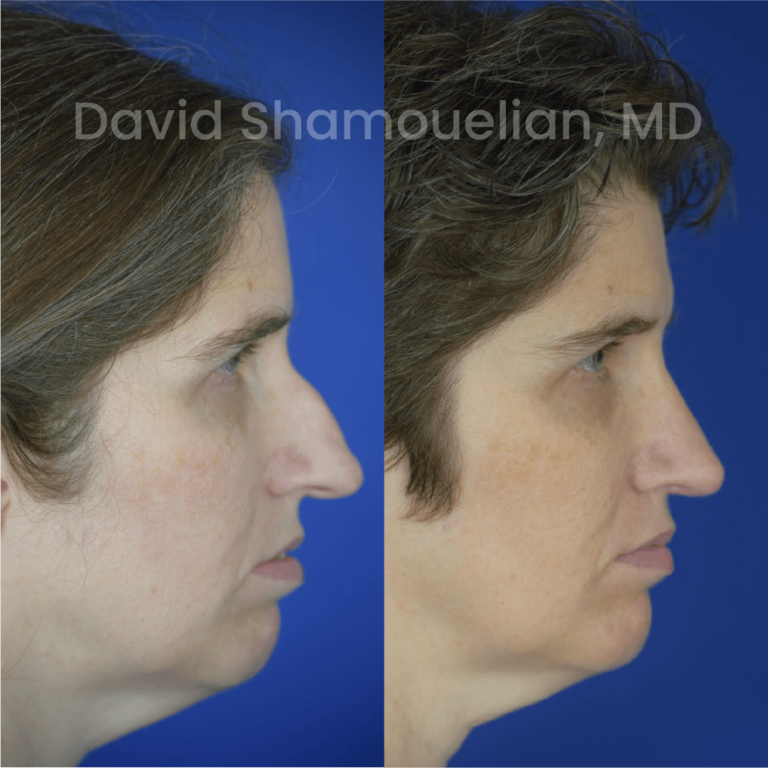 allure-bh-before-after-rhino-pt-31-06