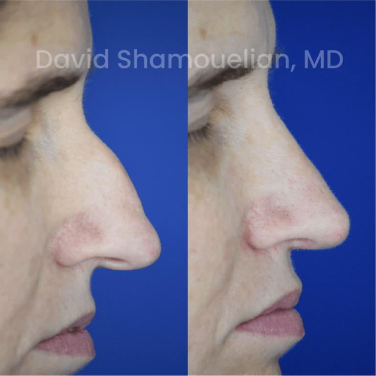 allure-bh-before-after-rhino-pt-31-07
