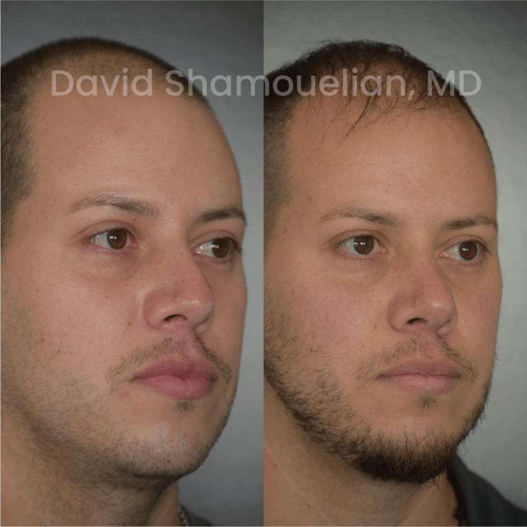 allure-bh-before-after-rhino-pt-32-02