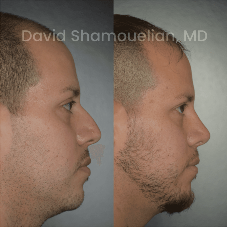 allure-bh-before-after-rhino-pt-32-03