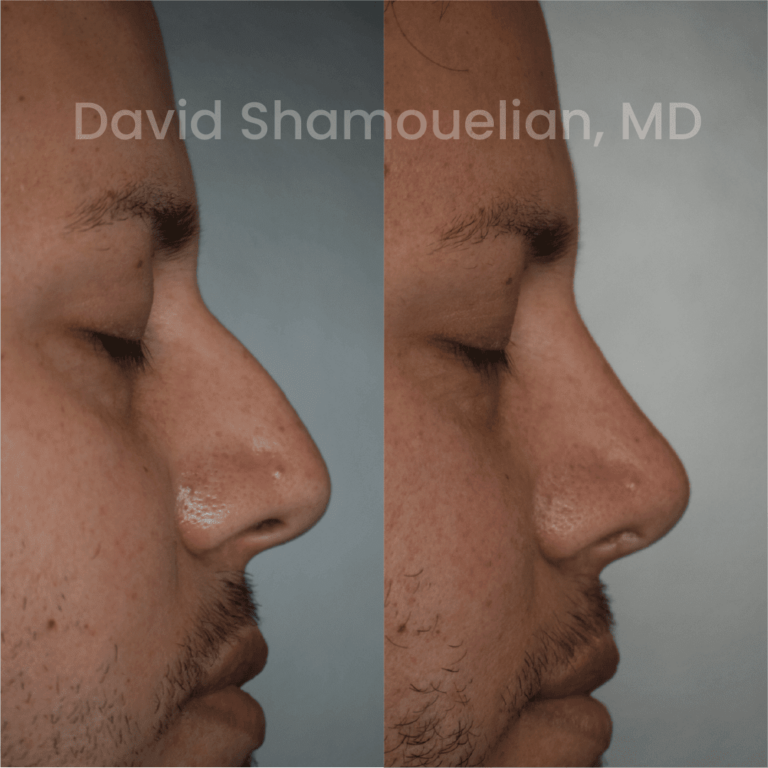 allure-bh-before-after-rhino-pt-32-04
