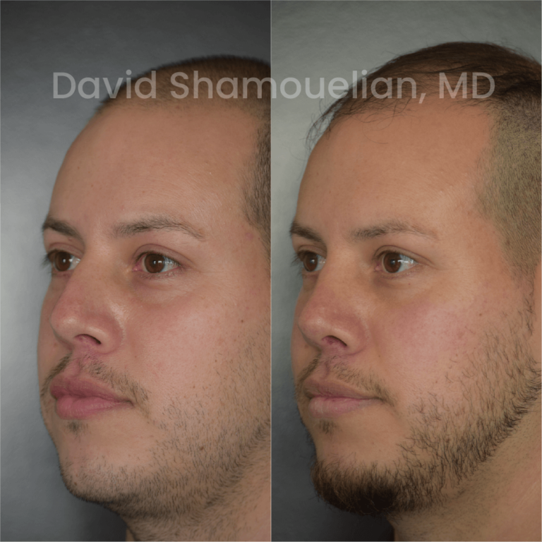 allure-bh-before-after-rhino-pt-32-05