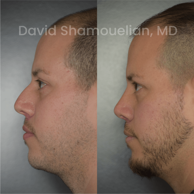 allure-bh-before-after-rhino-pt-32-06