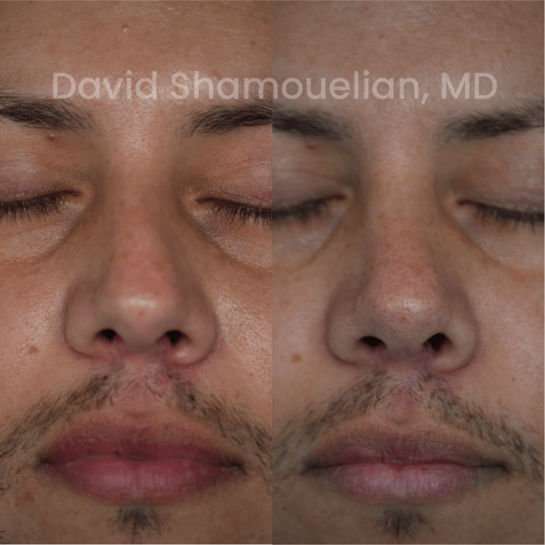 allure-bh-before-after-rhino-pt-32-09