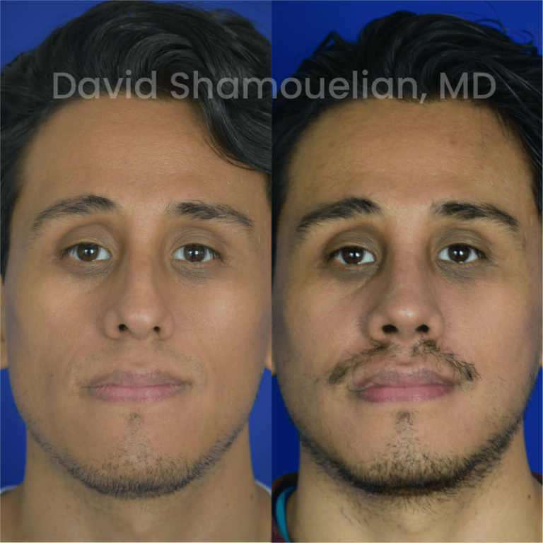 allure-bh-before-after-rhino-pt-33-01