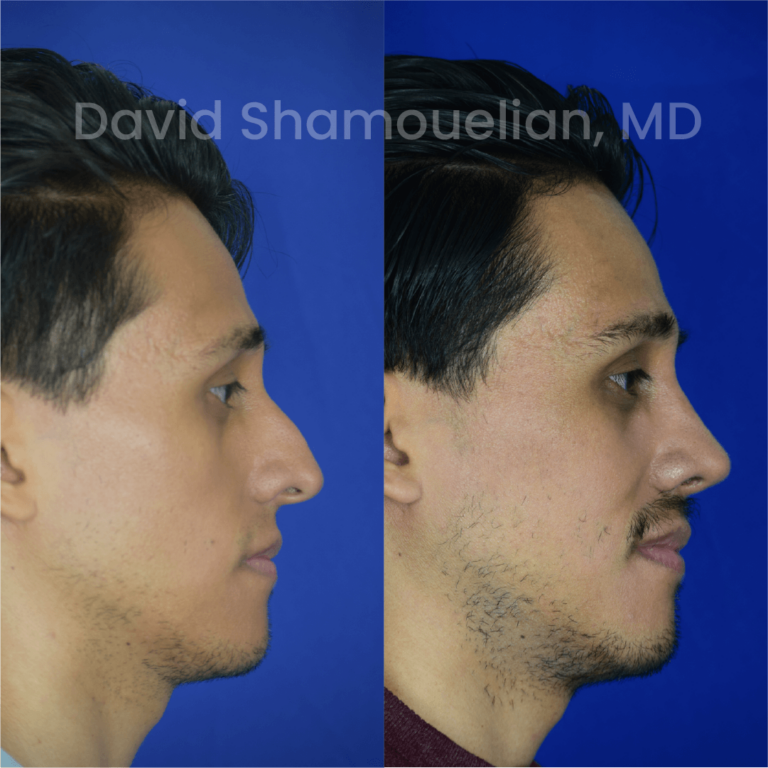 allure-bh-before-after-rhino-pt-33-02